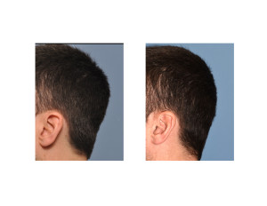 Occipital Skull Reduction result left side view Dr Barry Eppley Indianapolis
