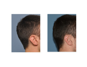 Occipital Skull Reduction result right side view Dr Barry Eppley Indianapolis