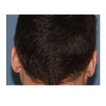 Occipital Skull Reduction scar Dr Barry Eppley Indianapolis