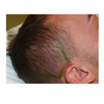 Posterior Temporal Zone of Wide Head Dr Barry Eppley Indianapolis