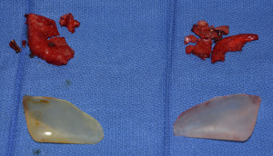 Remove and Replace Jaw Angle Imkplants intraop implants Dr Barry Eppley Indianapolis