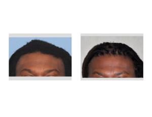 Sagittal Ridge Reduction Parasagittal Augmentation result front view Dr Barry Eppley Indianapolis