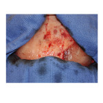 Sagitttal Reduction Parasagittal Augmentation intraop Dr Barry Eppley Indianapolis