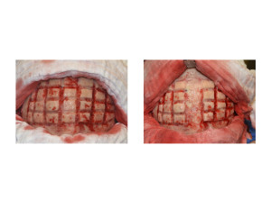 Skull Reduction surgical technique 2 Dr Barry Eppley Indianapolis