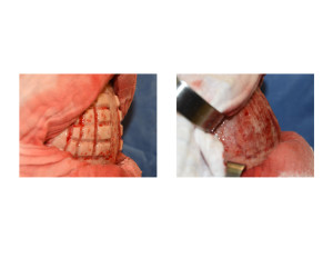Skull Reduction surgical technique 4 Dr Barry Eppley Indianapolis