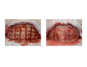 Skull Reduction surgical technique Dr Barry Eppley Indianapolis