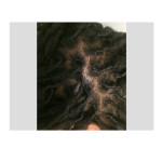 Skull Reshaping Scalp Scar Dr Barry Eppley Indianapolis