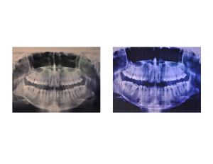 Submental Chin Reduction Planning