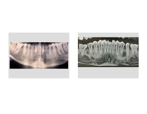 Submental Chin Reduction before and after radiographic results