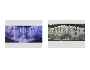 Submental Chin Reduction radiographic result predictgion planning vs actual result