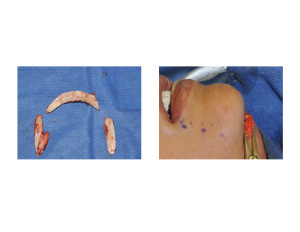 Submental Vertical Chin Reduction Dr Barry Eppley