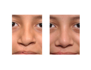 Teenage Cleft Rhinoplasty result front view Dr Barry Eppley Indianapolis