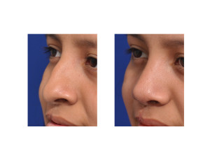 Teenage Cleft Rhinoplasty result left oblique view Dr Barry Eppley Indianapolis
