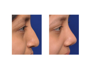 Teenage Cleft Rhinoplasty result side view Dr Barry Eppley Indianapolis