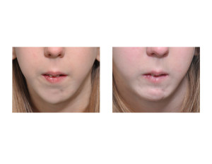 Teenage Jumping Sliding Genioplasty result front view Dr Barry Eppley Indianapolis