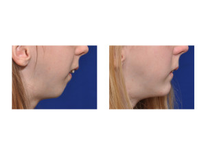 Teenage Jumping Slidinmg Genioplasty result side view Dr Barry Eppley Indianapolis