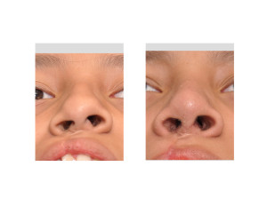 Teenasge Cleft Rhinoplasty result submental view