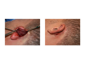 Temporal Reduction by Muscle Resection intraop Dr Barry Eppley Indianapolis