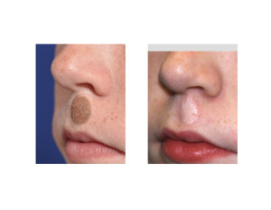 Upper Lip Nevis Excision with Skin Grafting result oblioque view Dr Barry Eppley Indianapolis