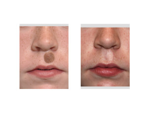 Upper Lip Nevus Excision and Skin Grafting result front view Dr Barry Eppley Indianapolis