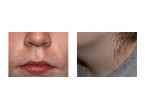 Upper Lip Nevus Skin Graft Neck Donor Site Scar Dr Barry Eppley Indianapolis