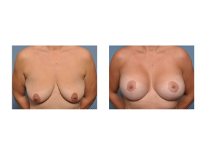 Vertical Breast Lift and Implants result front view Dr Barry Eppley Indianapolis