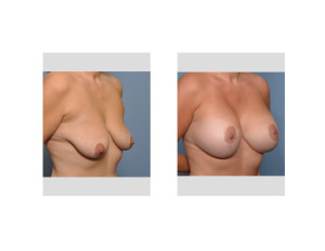 Vertical Breast Lift and Implants result oblique view Dr Barry Eppley Indianapolis