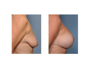 Vertical Breast Lift and Implants result side view Dr Barry Eppley Indianapolis