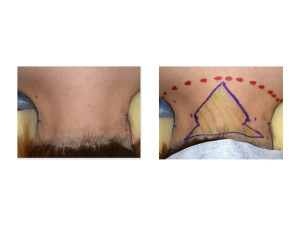 Webbed Neck Surgery Markings Dr Barry Eppley Indianapolis