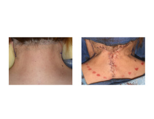 Webbed Neck Surgery before and after during surgery Dr Barry Eppley Indianapolis