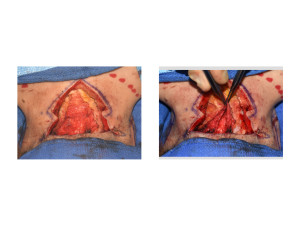 Webbed Neck Surgery fascial plication Dr Barry Eppley Indianapolis