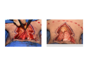 Webbed Neck Surgery fascial plication completed Dr Barry Eppley Indianapolis