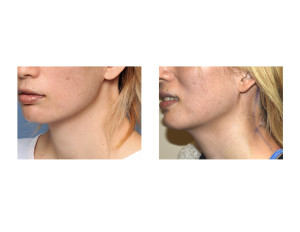 Webbed Neck Surgery left side result Dr Barry Eppley Indianapolis