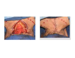 Webbed Neck Surgery skin closure Dr Barry Eppley Indianapolis