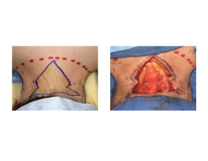 Webbed Neck Surgery tissue excision Dr Barry Eppley Indianapolis