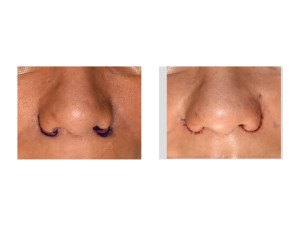 Alar Base Lowering front view result intraop Dr Barry Eppley Indianapolis