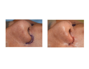 Alar Base Lowering result intraop side view Dr Barry Eppley Indianapolis