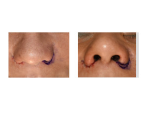 Alar Base Narrowing introp one side result Dr Barry Eppley Indianapolis