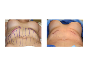 Anterior Rib Removals for Anterior Rib Protrusions intraop result Dr Barry Eppley Indianapolis