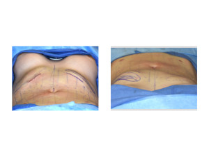 Anterior Rib Removals result intraop from one side Dr Barry Eppley Indianapolis