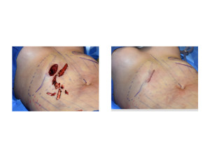 Anterior Rib Removals surgical technique 2 Dr Barry Eppley Indianapolis