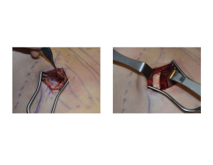 Anterior Rib Removals surgical technique Dr Barry Eppley Indianapolis