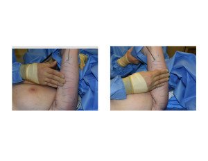Bingo Arm Liposuction intraop Dr Barry Eppley Indianapolis