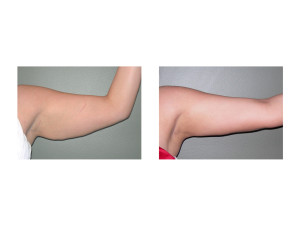 Bingo Arm Liposuction result left arm Dr Barry Eppley Indianapolis