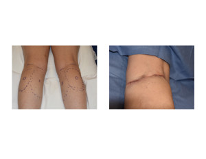 Calf Implant incisions Dr Barry Eppley Indianapolis