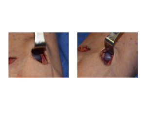 Calf Implant subfascial location Dr Barry Eppley Indianapolis