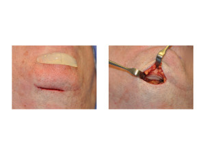 Chin Implant Removal Dr Barry Eppley Indianapolis