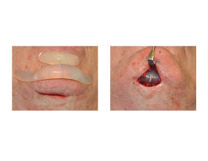 Chin Implant Replacement Dr Barry Eppley Indianapolis
