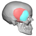 Extended Anterior Temporal Impalnt design side view Dr Barry Eppley Insianapolis