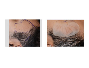 Extended Anterior Temporal Implants technique 1 Dr Barry Eppley Indianapolis
